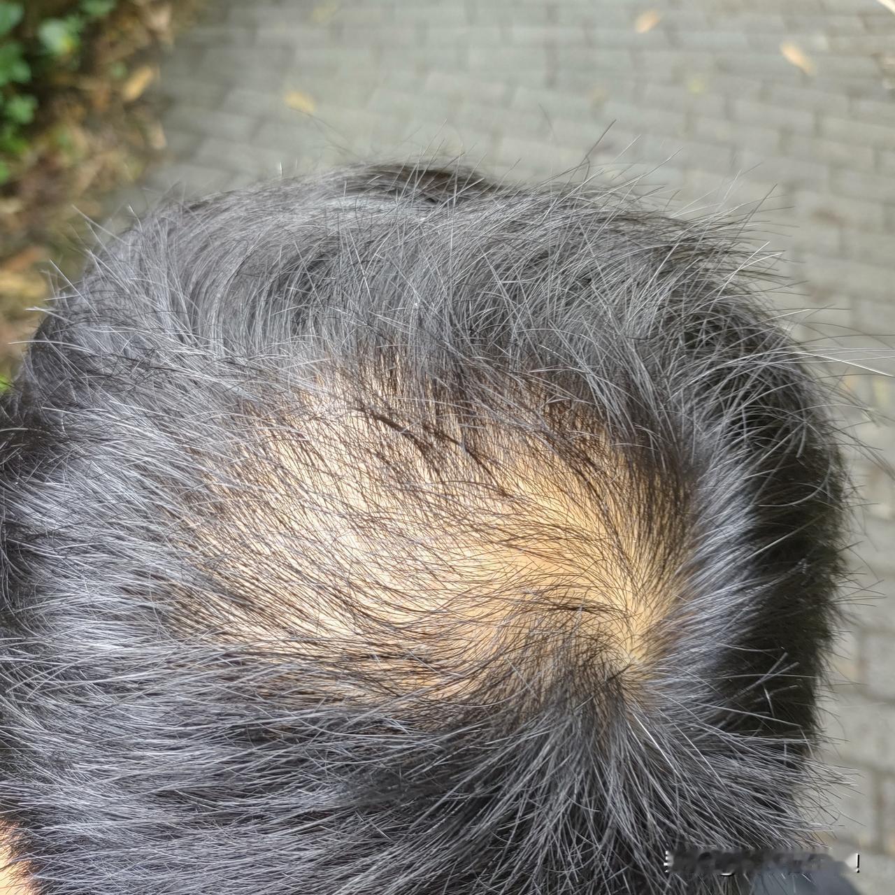 老夏一向自信，但这几年，秃头又大肚腩，终于开始着急了。尤其是秃头！我公公是个地中