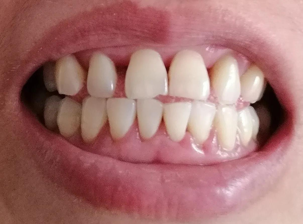 多亏了这些小习惯，这些年的牙周炎终于有所好转：
1、每日早晚两次认真刷牙，牙膏上