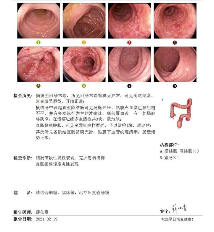 初诊疑似克罗恩合并结核患者后续反证为溃结。
诊断炎症性肠病，确实需要综合判断。
这位患者，21年初诊考虑克罗恩病（纵行溃疡＋节段性病变），同时tspot阳性（判断是否感染结核的检查，但是不能判断是否活动）。
于外院诊断性抗痨治疗，也做了胶囊内镜没有问题。
患者依从性并不好，抗痨治疗可能未完成。
22年肠镜表现更像不典型溃结，后按照溃结方案治疗，23，24都达到黏膜愈合，体重增长将近20斤。