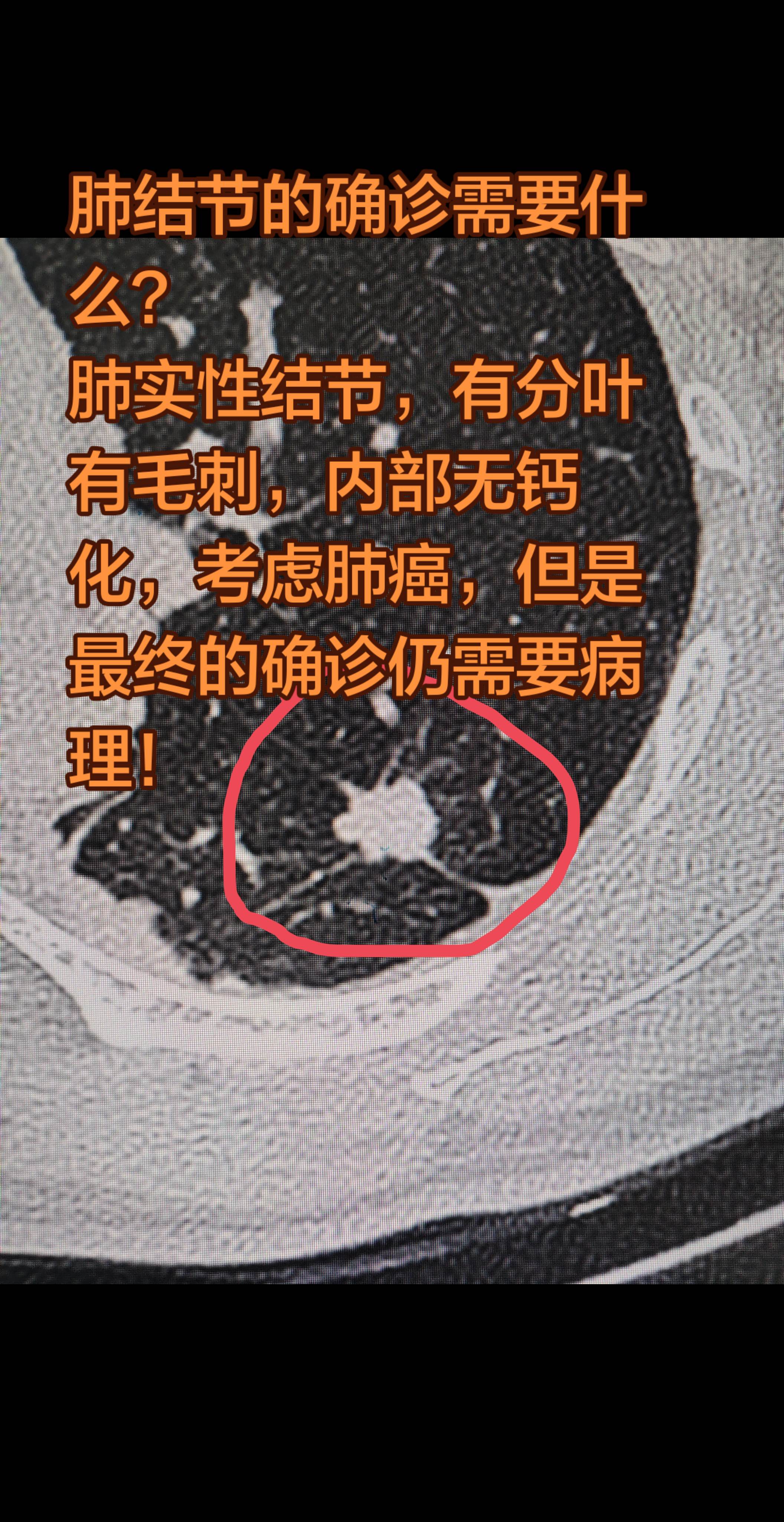 肺癌的确诊需要什么？肺实性结节，有分叶有毛刺，内部无钙化，考虑肺癌。 ...