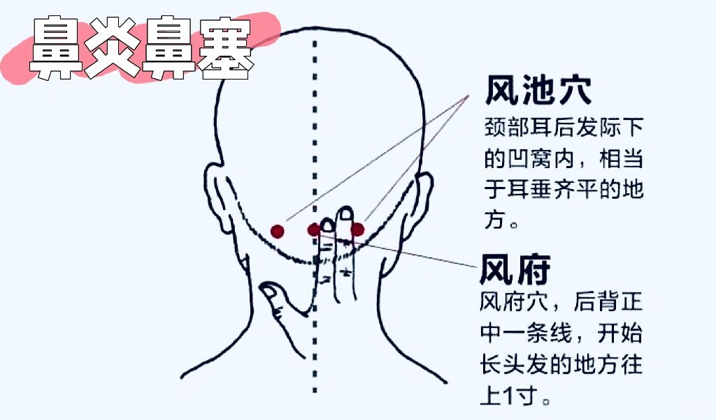 鼻炎 鼻塞