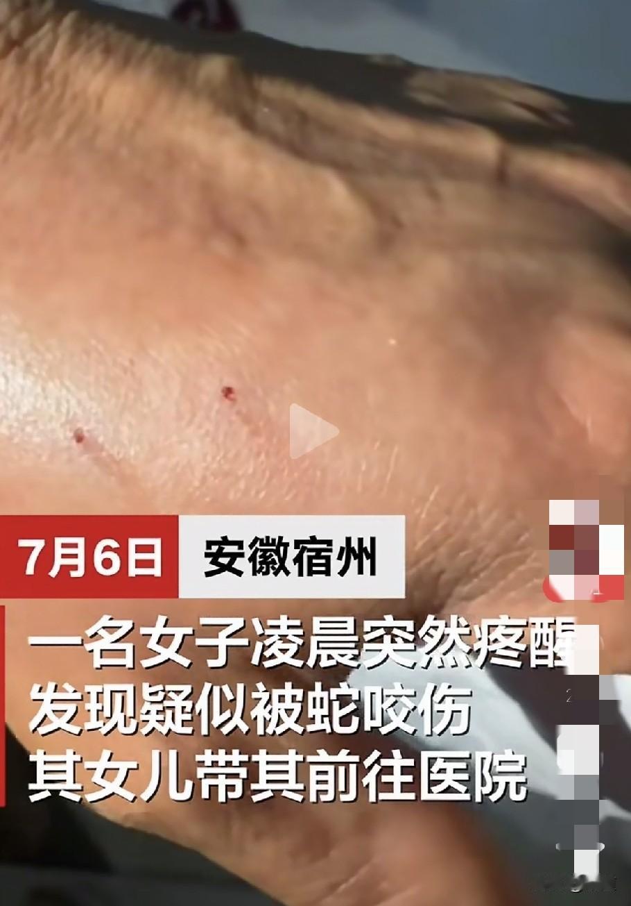 7月6日，安徽宿州，女子凌晨手被疼醒，一看手背上有两个针眼，就怀疑是毒蛇咬伤。