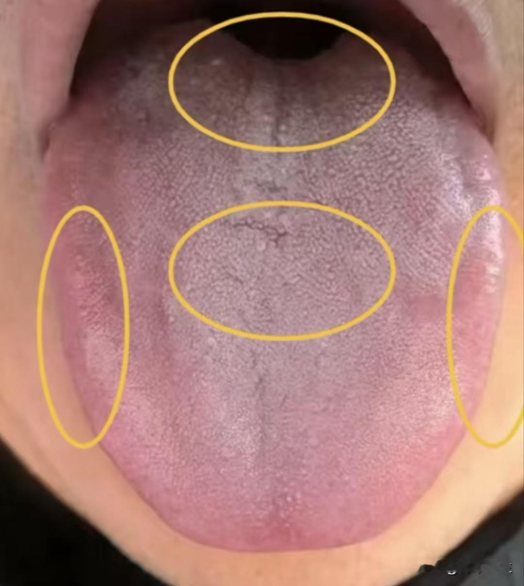 这样的肾精亏虚，吃多少的五子衍宗都没用，补不进去，还上火

补肾苔容易进入误区了