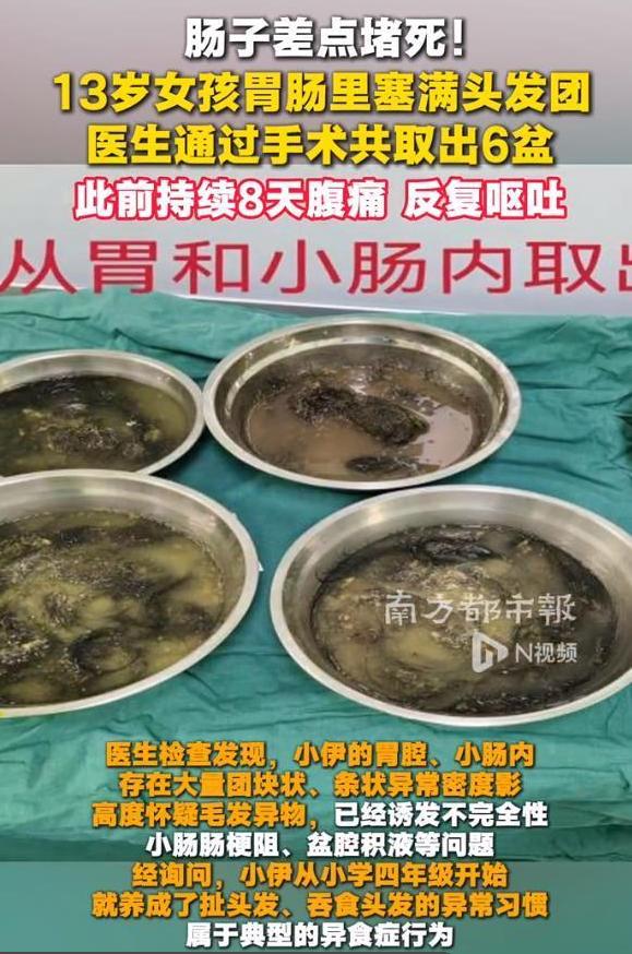 一名 13 岁女孩的胃中，为何会有 6 盆头发？真相令所有家长陷入沉默。

你家