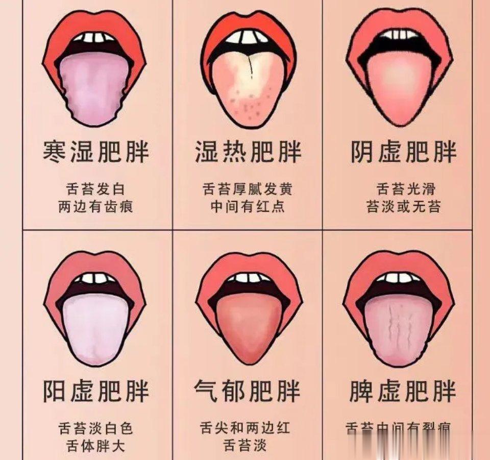 肥胖患者常见舌苔，中医教你判断肥胖体质​1、寒湿：舌苔发白，舌头两边有齿痕​调理