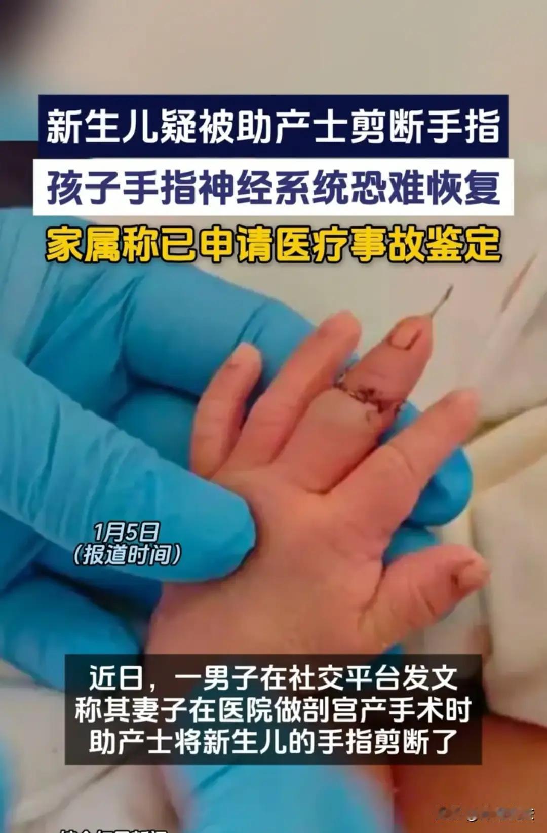 宝宝当时得有多疼啊，被硬生生剪断手指，长大了也可能会自卑，如果孩子开朗还好。但是