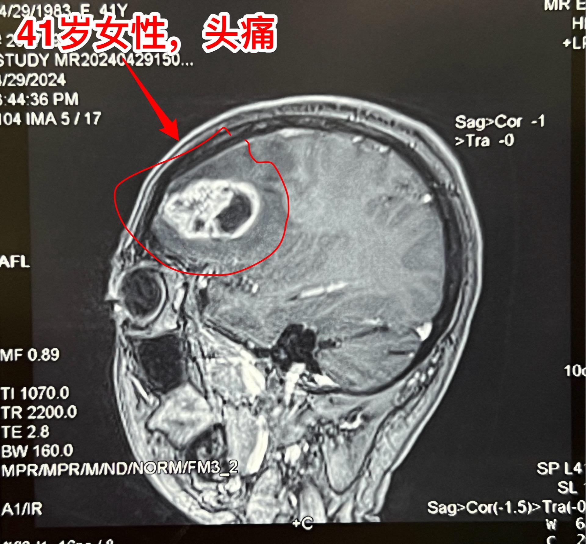 脑肿瘤导致病人头痛，是胶质瘤吗？脑部最常见的肿瘤是胶质瘤。
这个41岁女性病人本身是医务工作者，头痛十天了，4.29到医院去检查脑部CT、磁共振，发现这个肿瘤。肿瘤周围有水肿，脑部受压移位，发现肿瘤后立即到北京来治疗。4.30作了手术，将肿瘤完全切除，手术后病人没有出现失语症状，四肢活动也有力。
           术中判断肿瘤为胶质瘤，确诊需要等病理诊断。