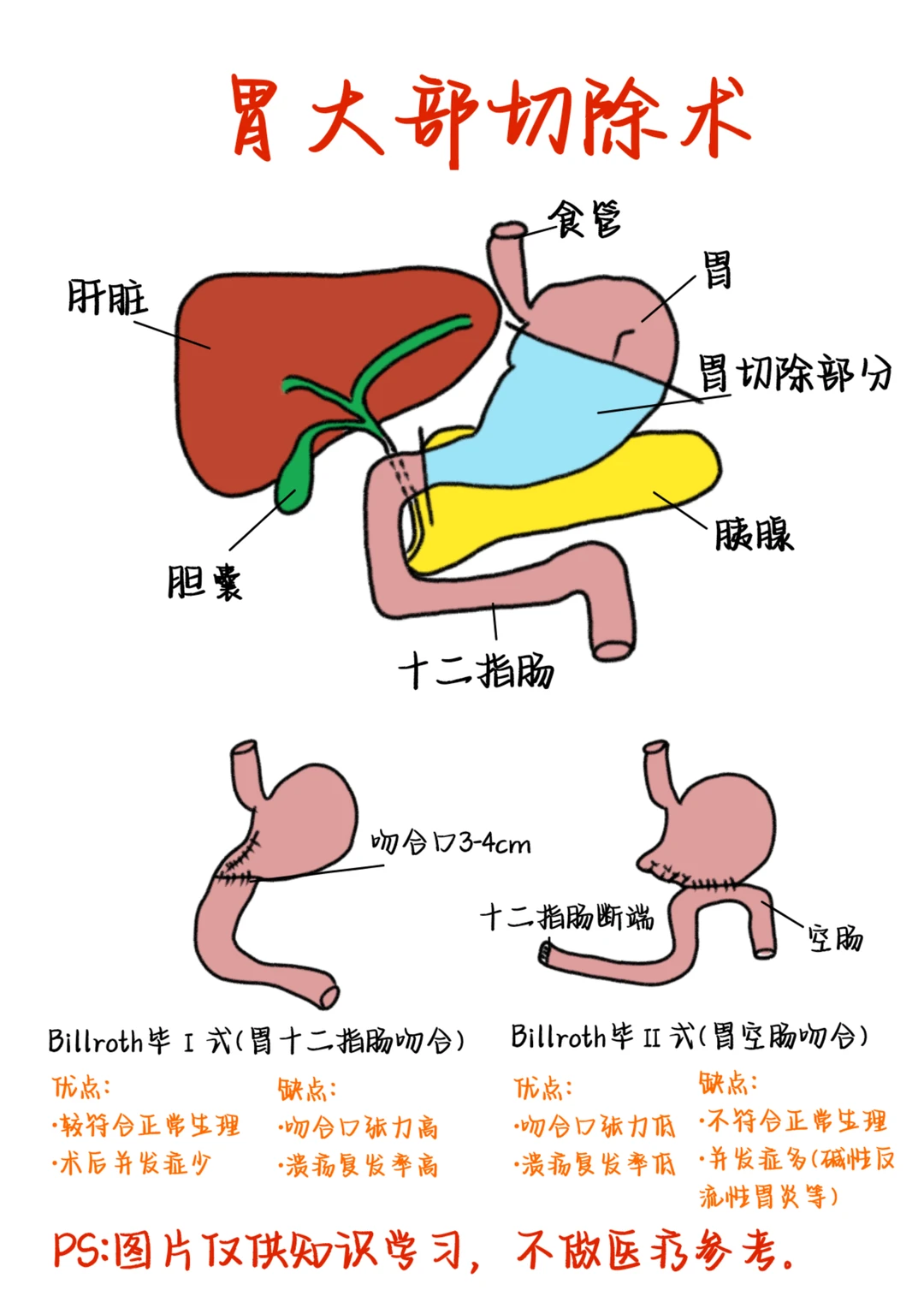 医学生笔记——胃大部切除术
