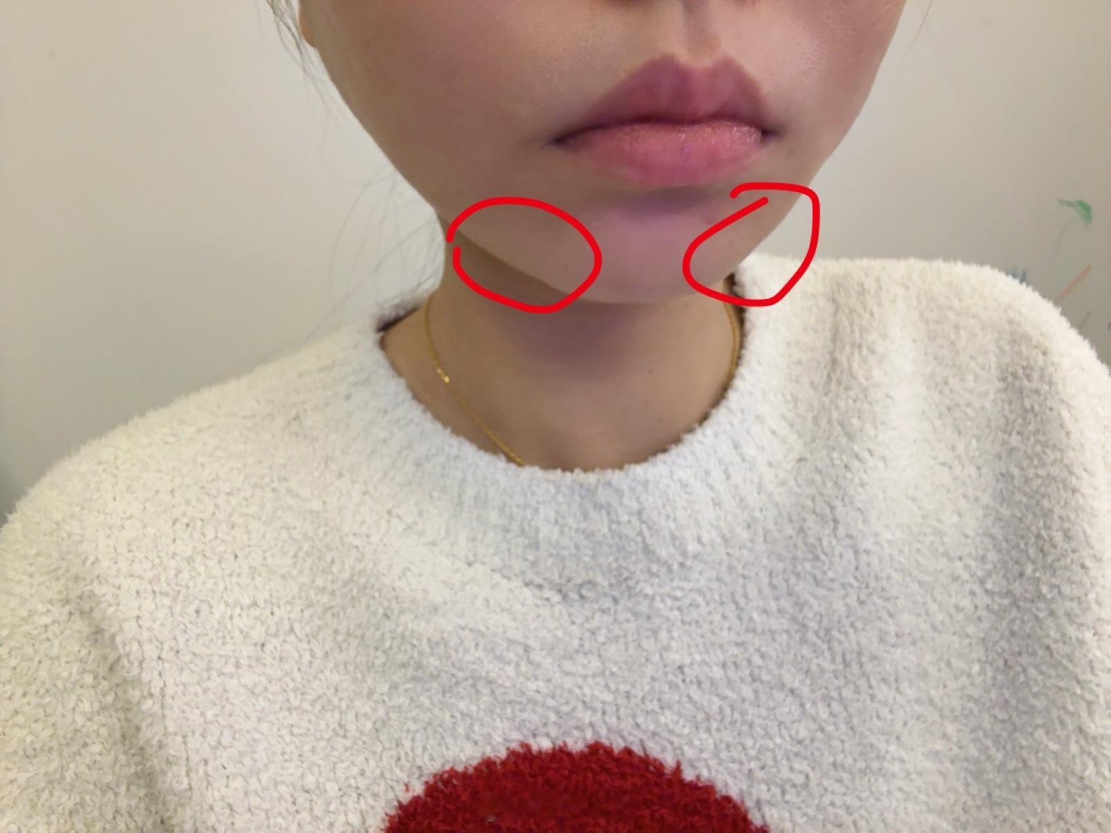 我现在脸巨痛！跟家人们汇报一下今天打了啥下巴用瑞兰丽缇填了两边的凹陷处botox