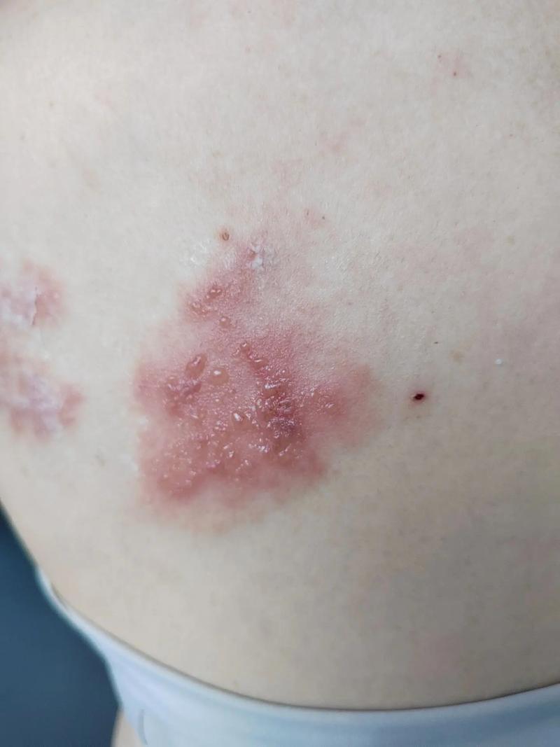 带状疱疹。得了这种病，很是疼啊！医学上主张应用抗病毒药物、营养神经药物！