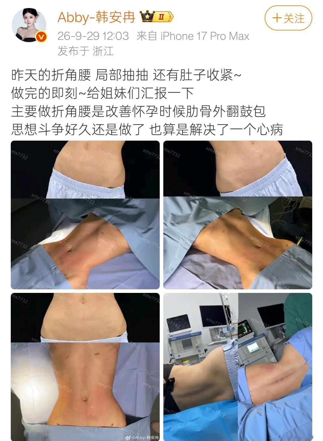 这姐妹真是狠人，为了腰变细，竟然把腰上的肋骨都取了？
感觉她不是在整容就是在整容