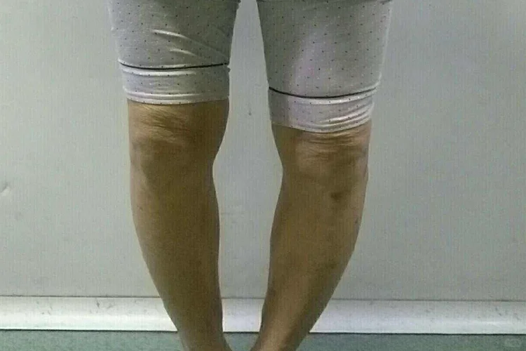 罗圈腿是什么样子