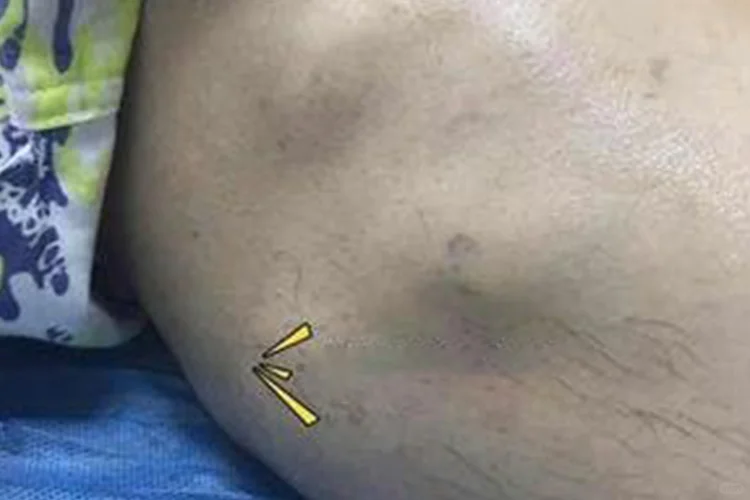 大腿外侧肉凸出来图片