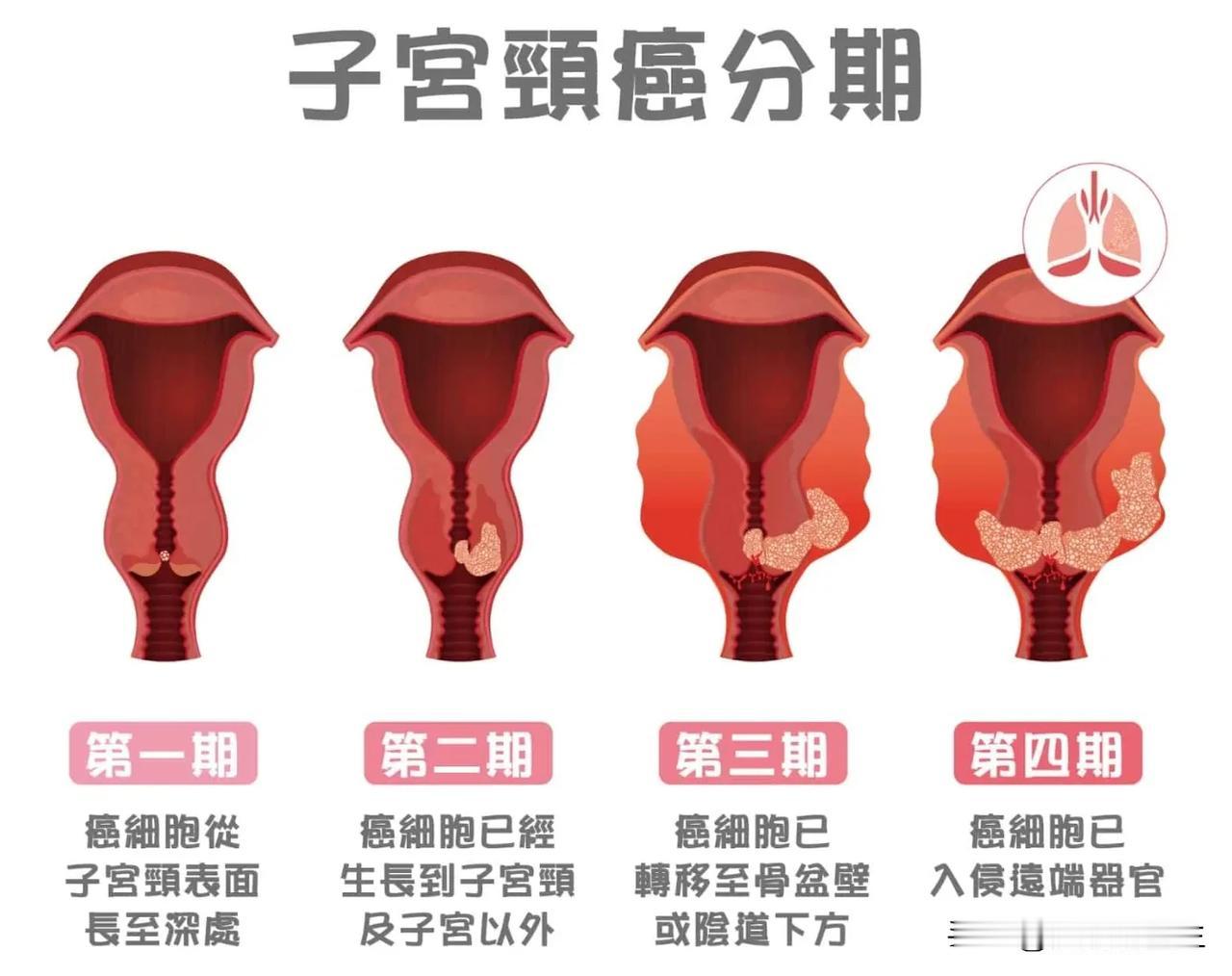 宫颈癌，这是一个非常好预防的肿瘤，很多时候罹患宫颈癌是来自于病人对于自己身体的忽