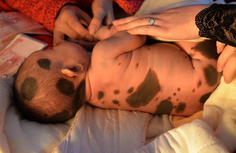 宝宝产检正常出生后满身兽皮痣，妈妈回应孩子出生后满身兽皮痣近日河南，“身上90%