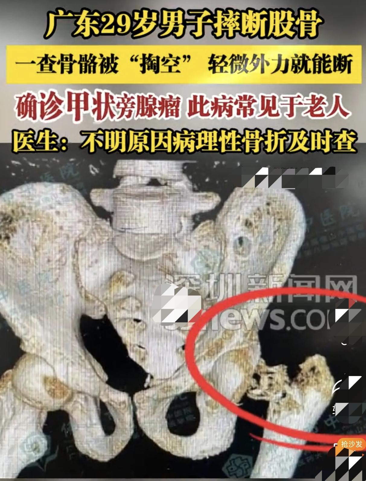 被吓到了！广东29岁男子摔断股骨，一查骨骼被“掏空”轻微外力就能断，确诊甲状旁腺