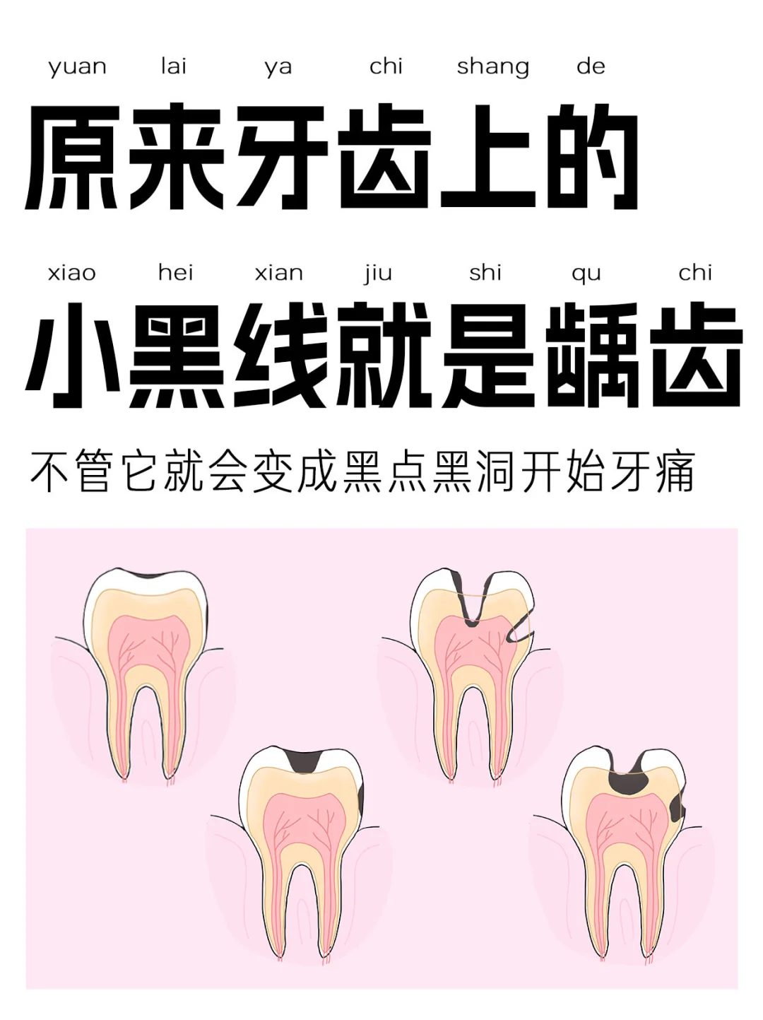 牙医警告:忽视后槽牙上的小黑线后果很严重