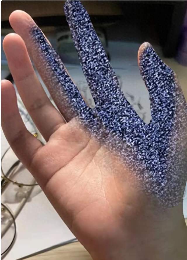 右手麻了六年花近十万治颈椎，最后确诊腕管综合征，教训太深刻
