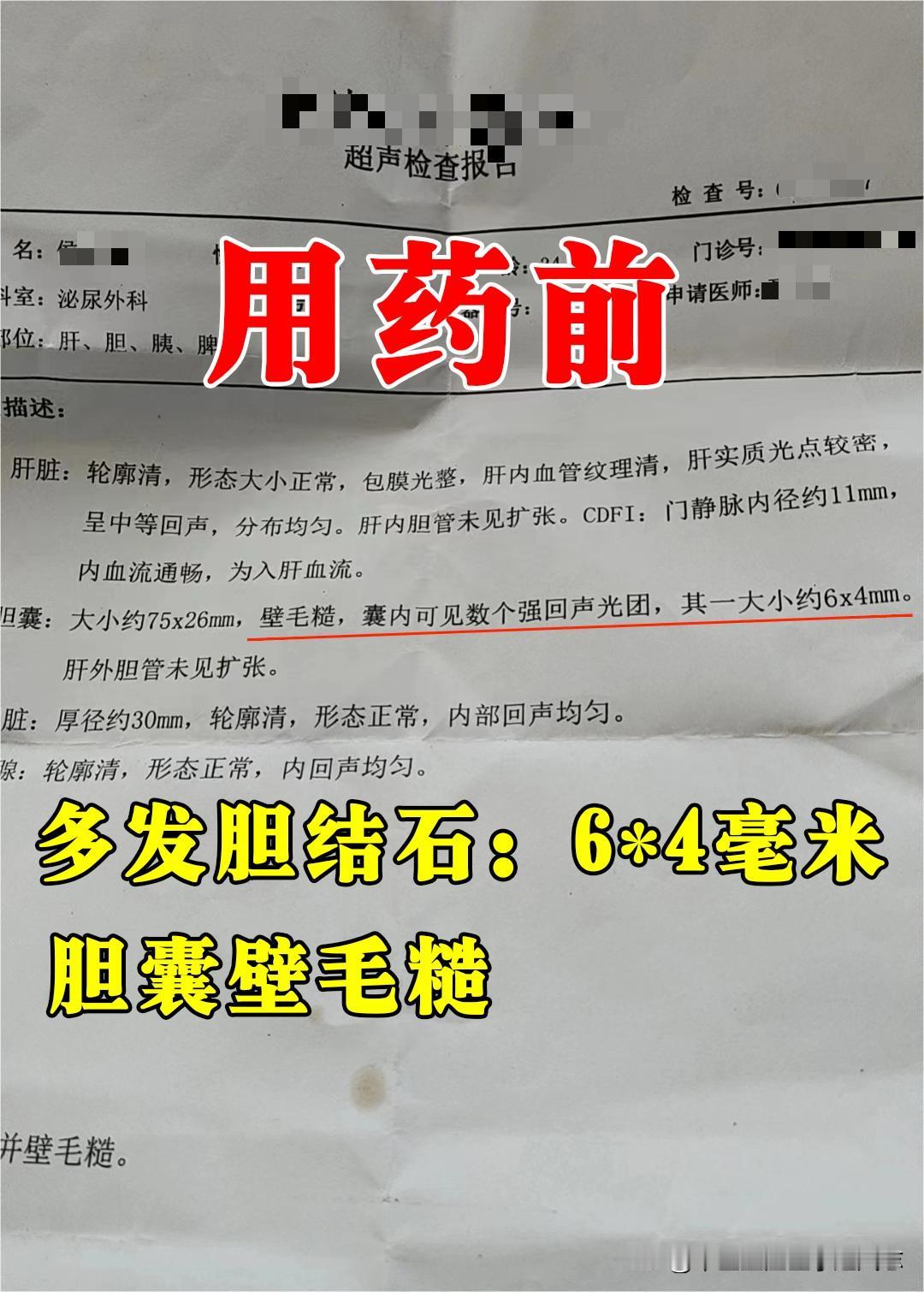 关于结石的问题，有的溶石化石相对较快，有的相对较慢，这个因人而异，受多种因素所决
