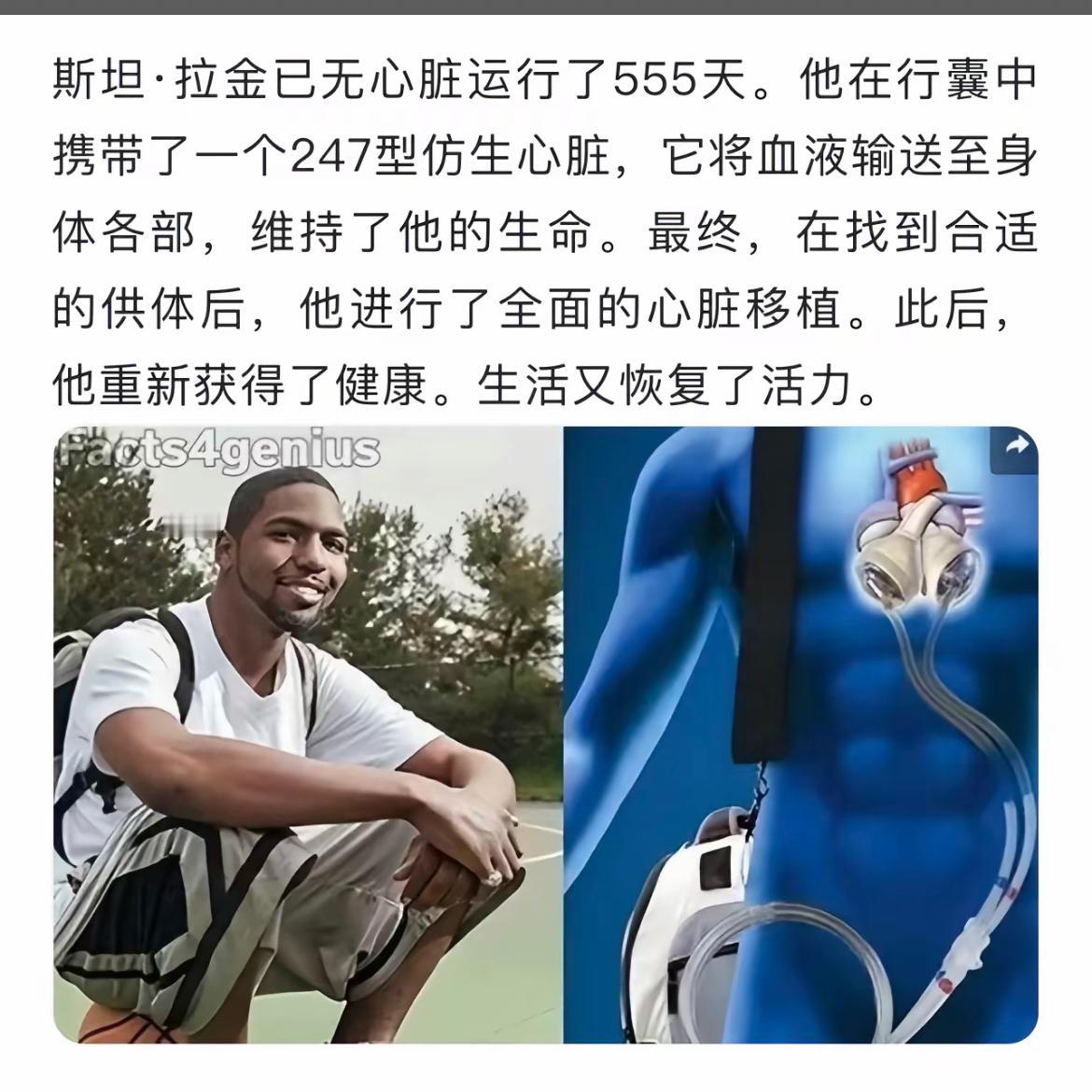 斯坦·拉金的情况体现了现代仿生心脏技术的重大突破。247型仿生心脏作为一种心室辅