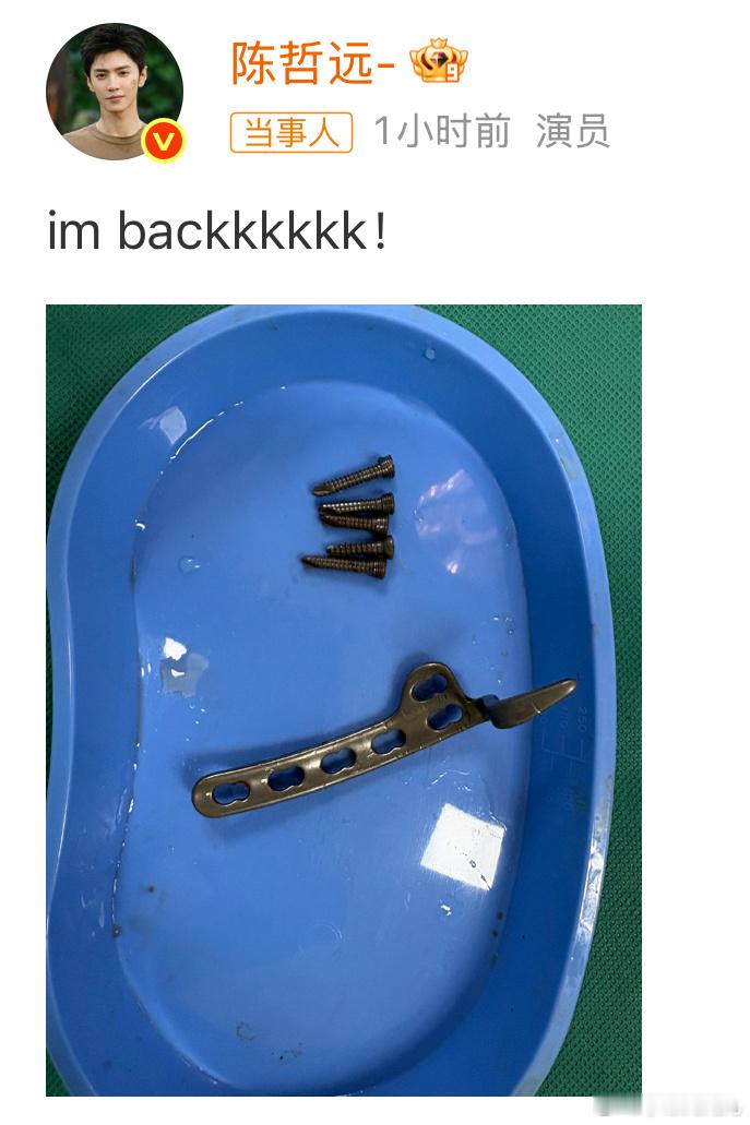 陈哲远晒手术取出的钢钉我天……这么长一根钢钉