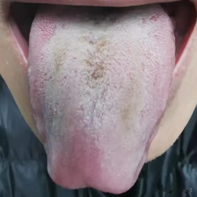 舌象分析：胃气不足 燥结腑实 气滞不通
1、“舌苔剥落”——胃气不足。舌苔是胃气
