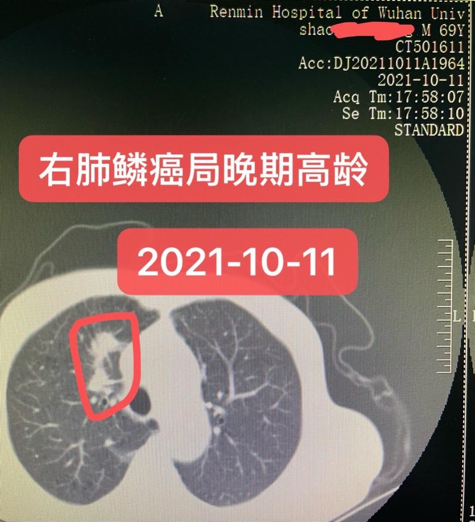 肺鳞癌局部晚期-高龄未手术！无瘤长生存。72岁，男性，确诊右肺鳞状细胞...