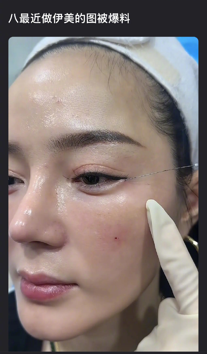 瓣人说这是迪丽热巴最近做医美的照片，热巴的鼻子没有这么低和短吧！ ​​​