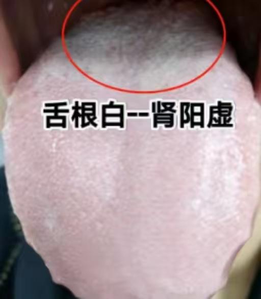 男人补肾记住这九个字：白补阳，红补阴，凹补气！

今天分享一招如何从舌象上进行补