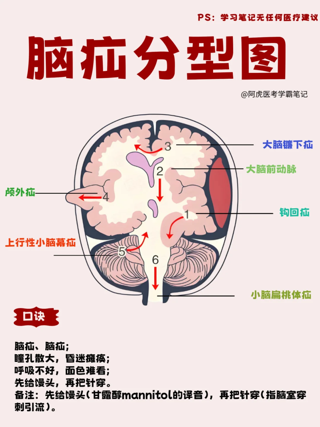医学生笔记📒：脑疝分型图👆