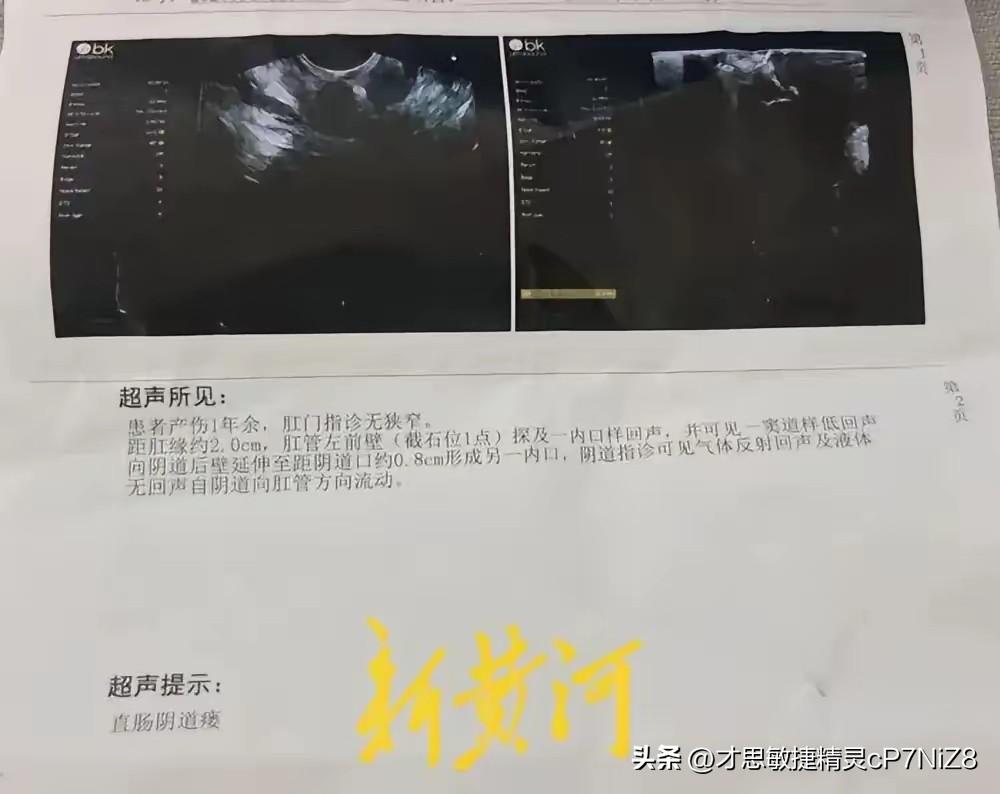 “河北任丘，女子在医院顺产生下一子，谁料3天后，她如厕时竟从阴道排出大便，一查才