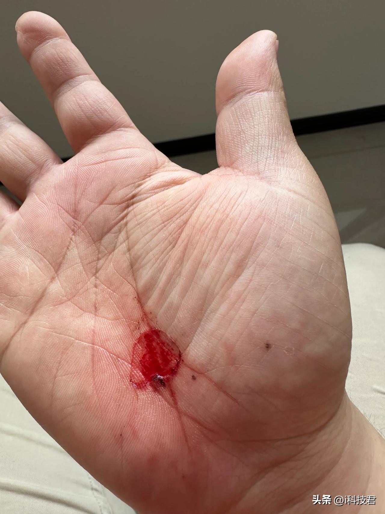 周末骑自行车跑个长途，不小心摔了，还好戴了手套，手心只是擦伤，本来像我这么谨慎的