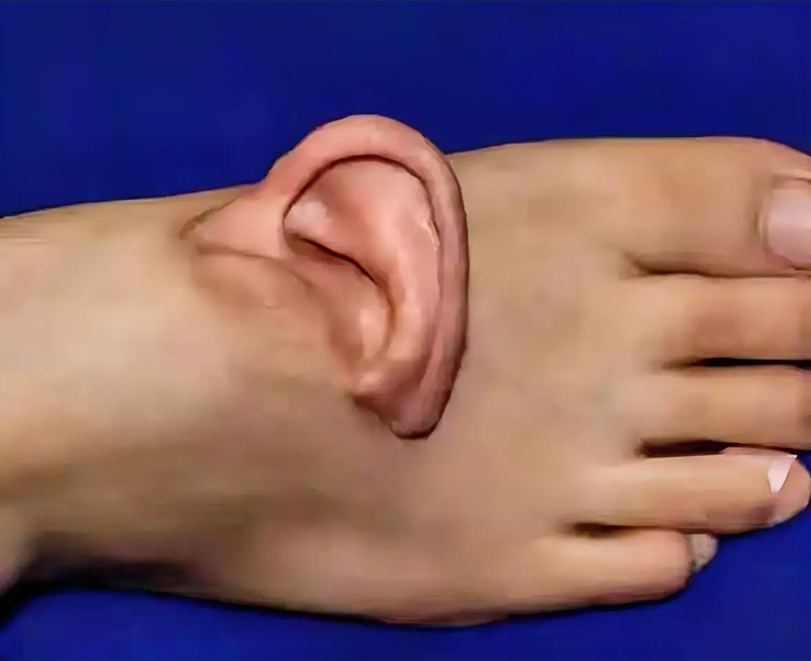 山东女子的经历太神奇了！一场意外让她的左耳离断，医生竟把耳朵寄养到脚背上，此后她