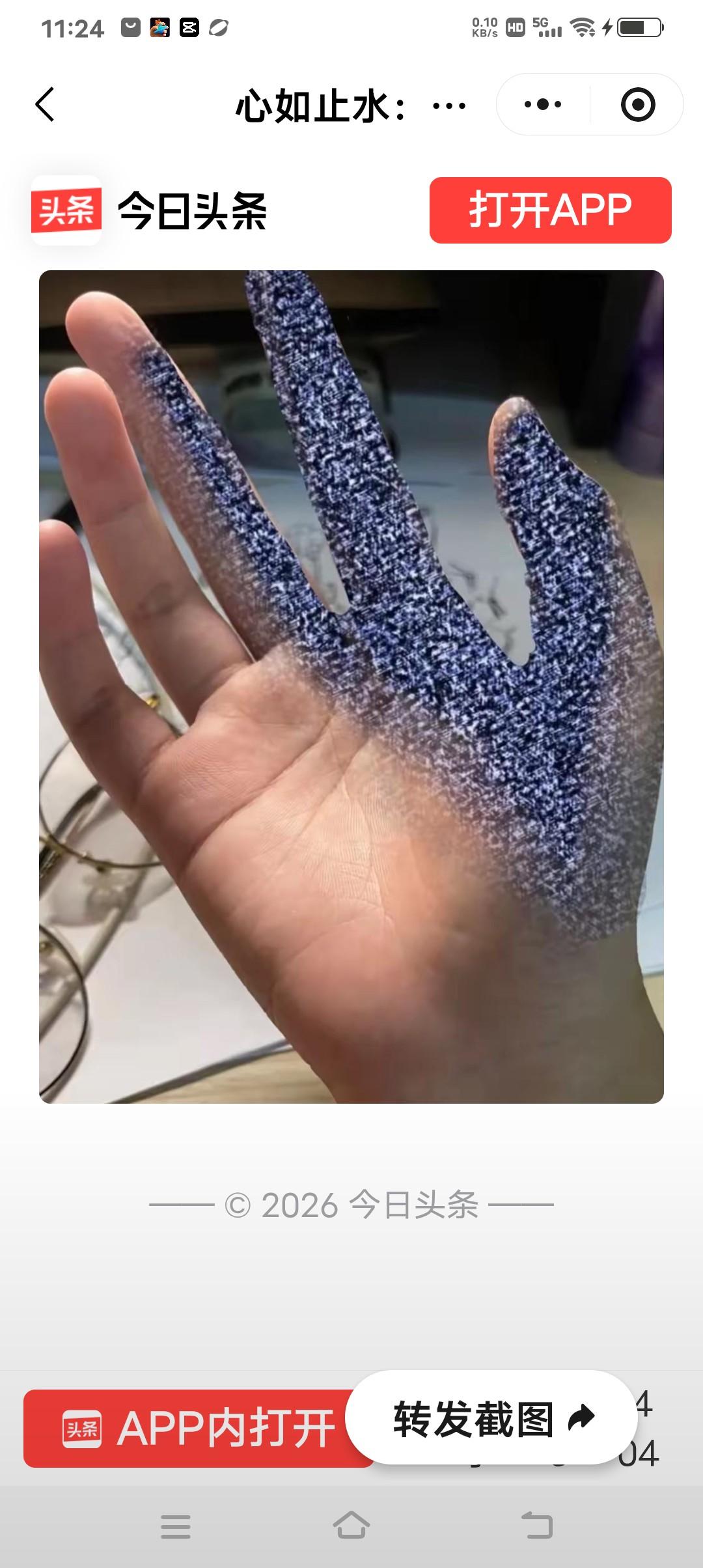 手麻六年，我竟然一直治错了地方
六年的右手发麻，十来位大夫，小十万块钱，三台理疗