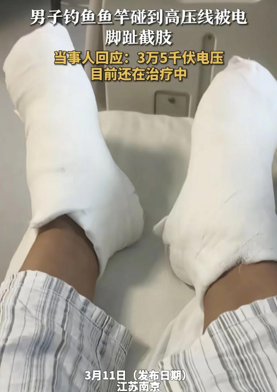 江苏南京一男子钓鱼时鱼竿碰到高压线，脚趾被截肢，男子说当时高压线电压在35,00