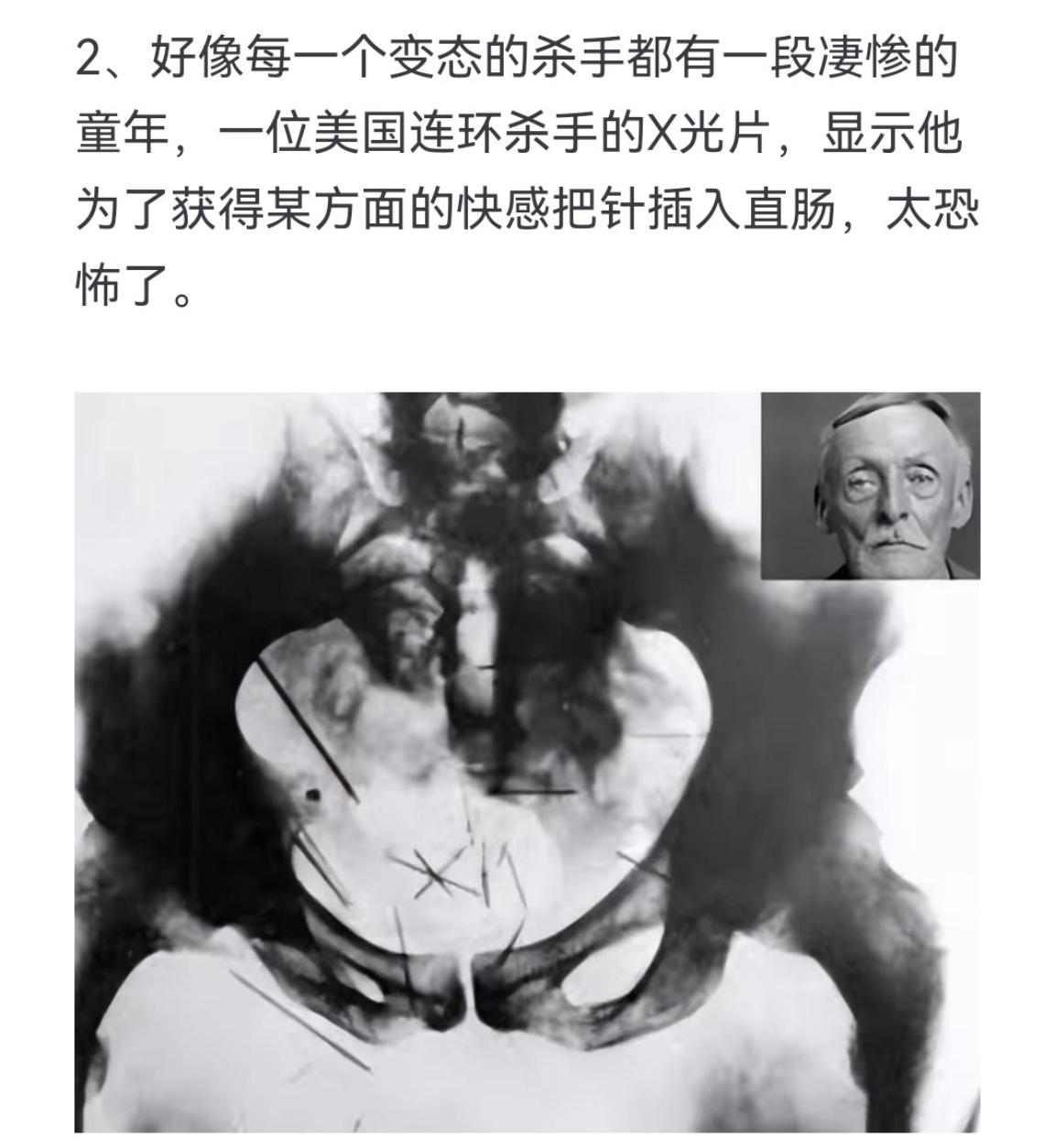 好像每一个变态的杀手都有一段凄惨的童年，一位美国连环杀手的X光片