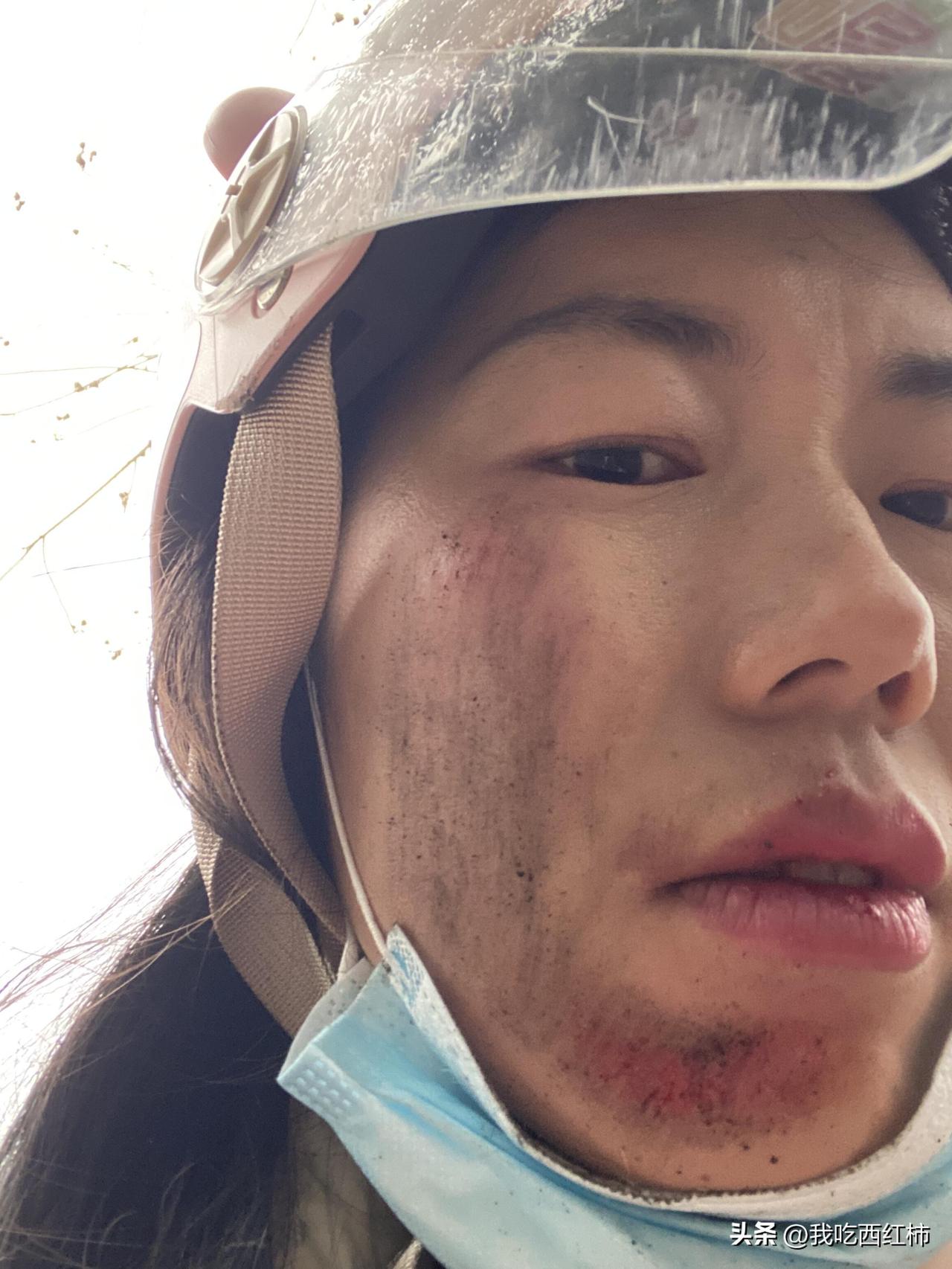 电动车🛵摔倒了
噢 天呀 我的脸在地上摩擦了
疼哭😭了两天
自己摔的 自己疼