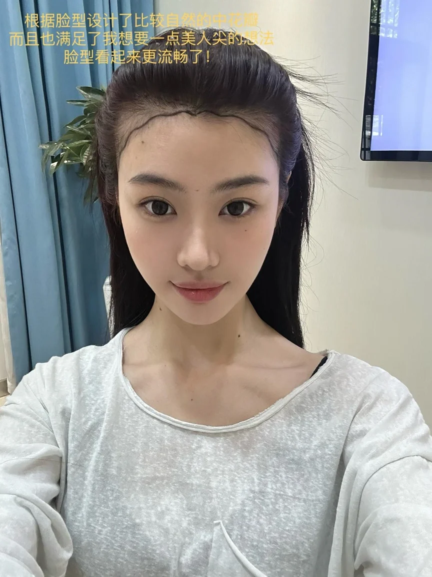 Do脸坦白局｜植发真的超值！发际线粉都省了