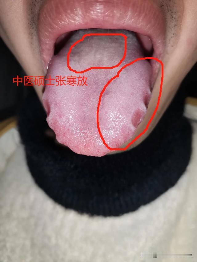 一旦遇上这种舌头，可不是简单的脾虚湿盛了[狗头][狗头][狗头]
要是你以为健脾