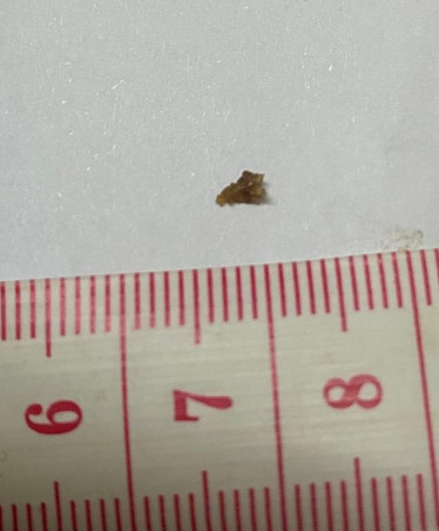 就这么个小东西，多么不起眼，却能把人搞得超级痛，痛不欲生那种。
据估算这个小结石