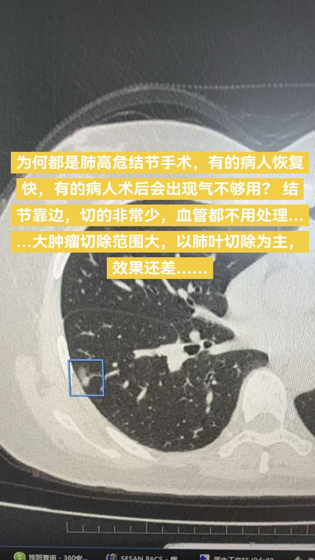 有手术指征的高危肺结节（肺癌）建议早处理……