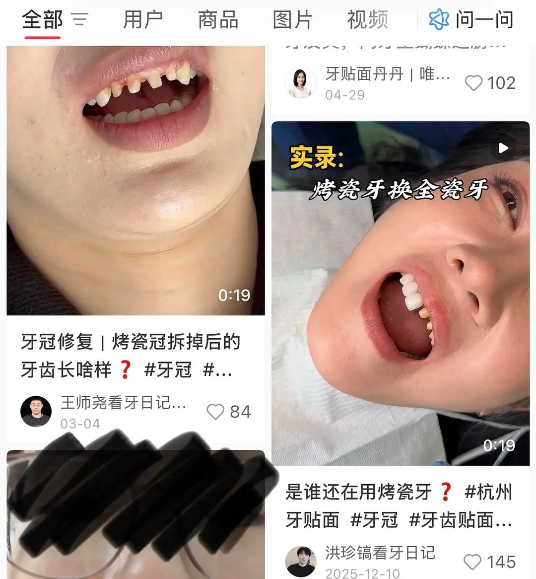 才知道烤瓷牙是要把自己的牙磨小再套牙冠😨吓人 