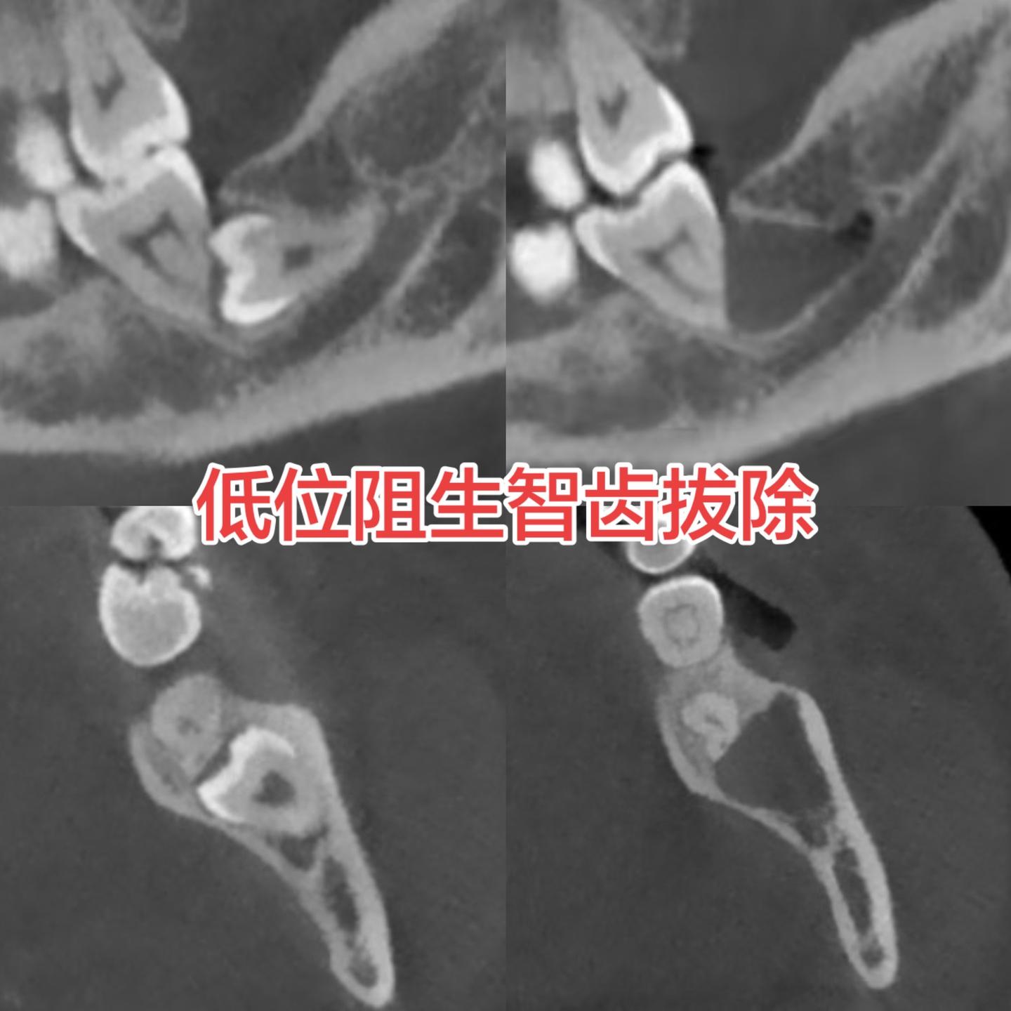 低位阻生智齿拔除。还是发现的晚了，智齿导致前牙牙根有吸收了