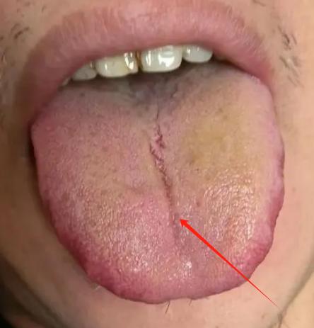 舌中纵裂 + 舌红苔黄？这是肝郁火 “烧干” 了津液，舌头才裂了！
大家好，我是