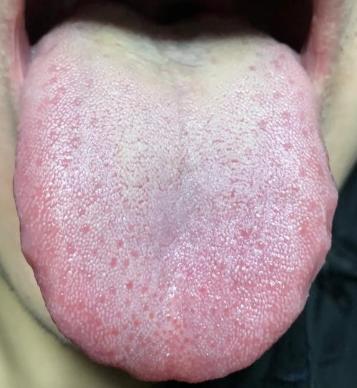 时间短，难坚守，补肾药不仅没用，反而还上火？其实问题在肝脾！

主诉：时间短，行
