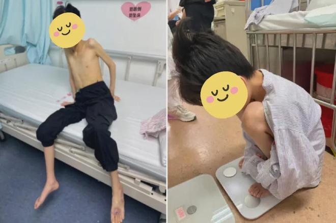 “让人心碎的青春！”江西，17岁少年身高1.5米，体重仅21.2公斤，BMI低至