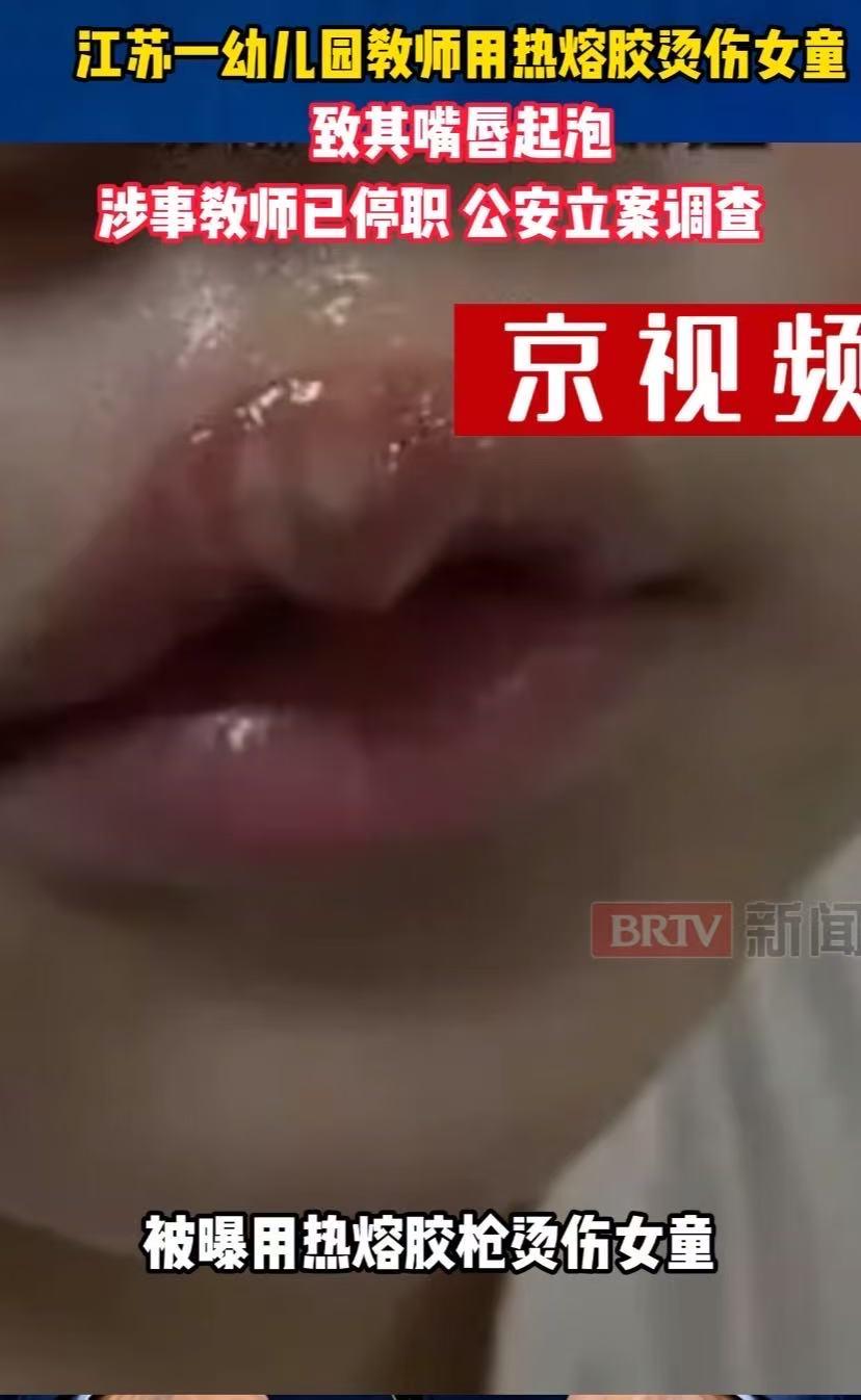 这名幼师有多狠心？用热熔枪烫女童嘴，另一个老师就在旁边看着。

5月29日，丰县