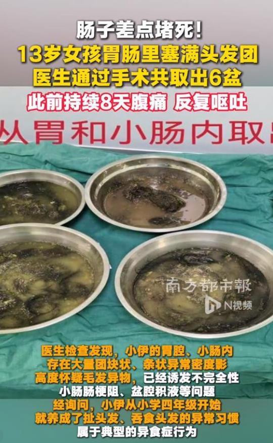13 岁女孩的胃里，竟取出 6 盆头发！真相让所有家长沉默。
 
这事发生在广东