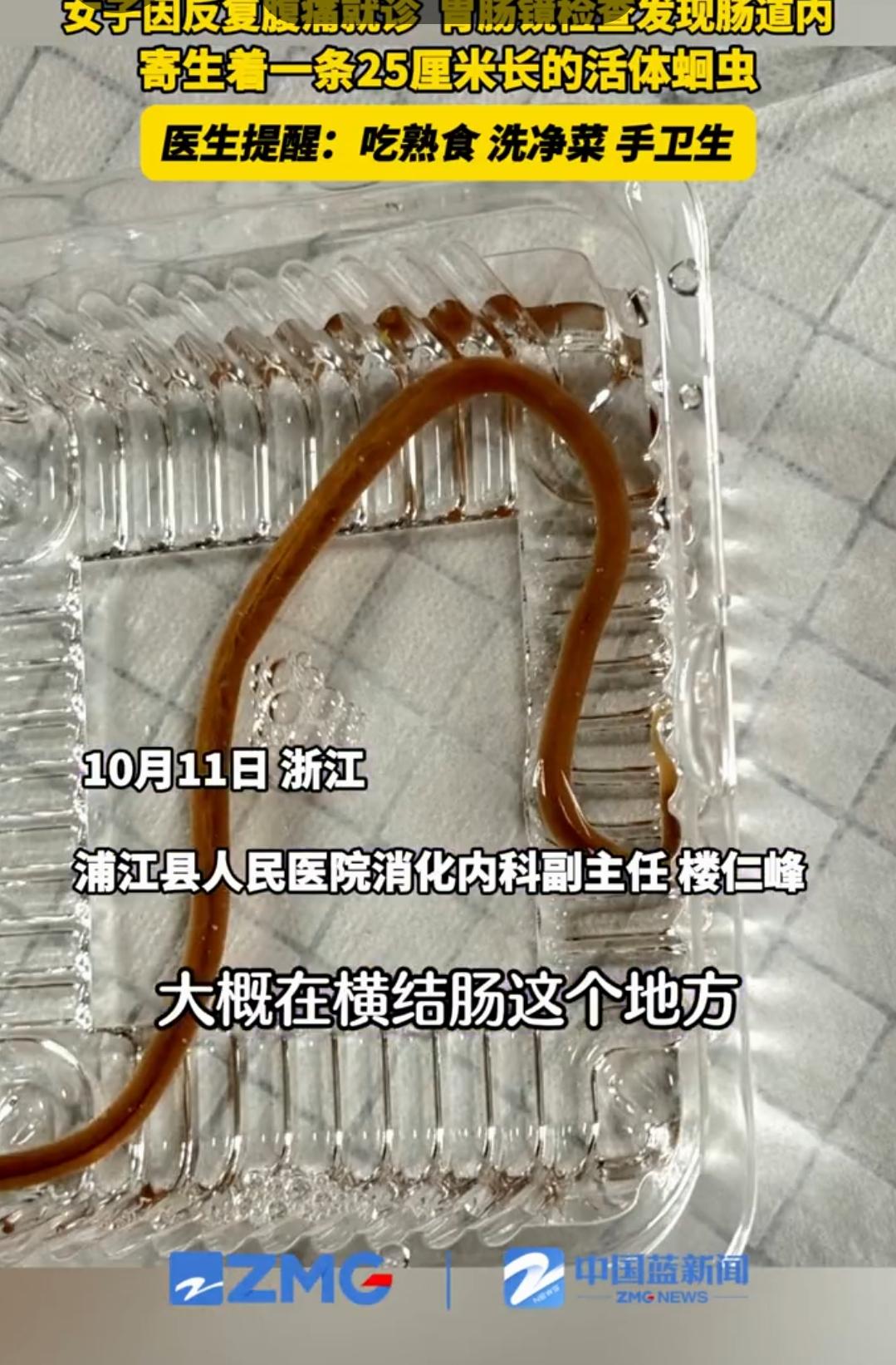 女子腹痛就医，肠道内竟寄生活体蛔虫！
近日，浙江金华，浦江县人民医院消化内科接诊