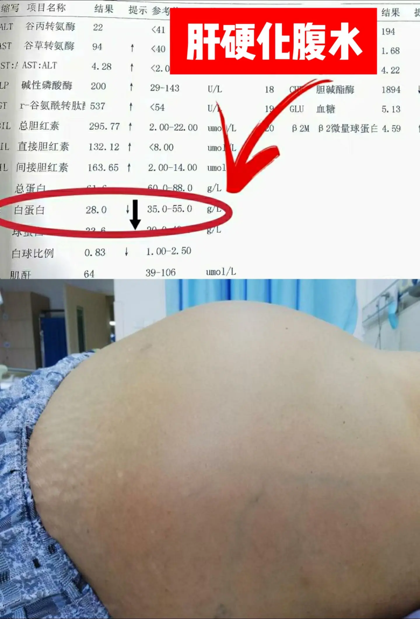 乙肝肝硬化大肚子腹水，多因为这4个原因！乙肝肝硬化腹水的原因主要包括乙...